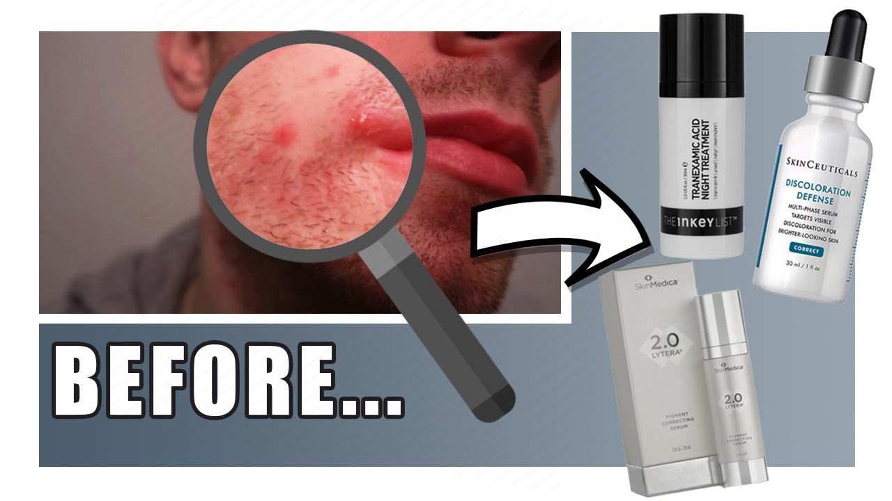 What Is Tranexamic Acid + How To Use It | Skincare Secrets