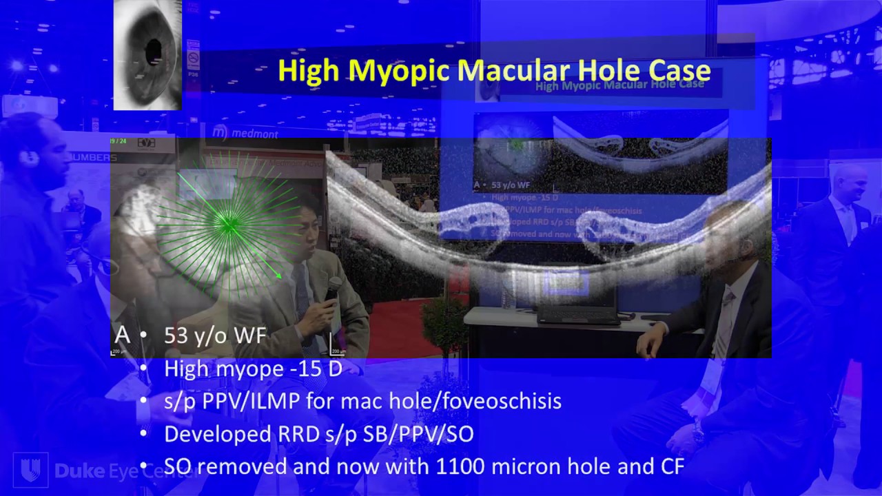 Emerging Data and New Approaches to Retina Surgery - Tamer Mahmoud, MD, PhD Panel - AAO 2016