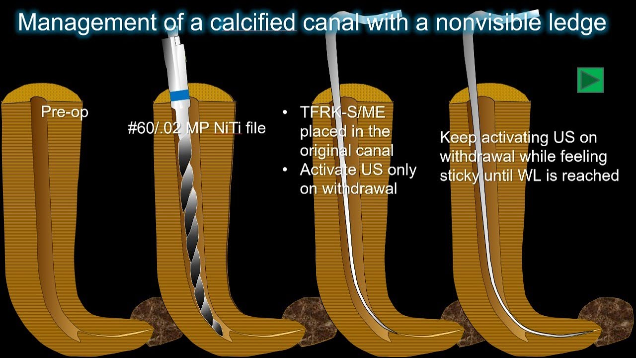 Bypassing ledges and canal instrumentation with TFRK S/TFRK-Sでレッジバイパスと根管形成