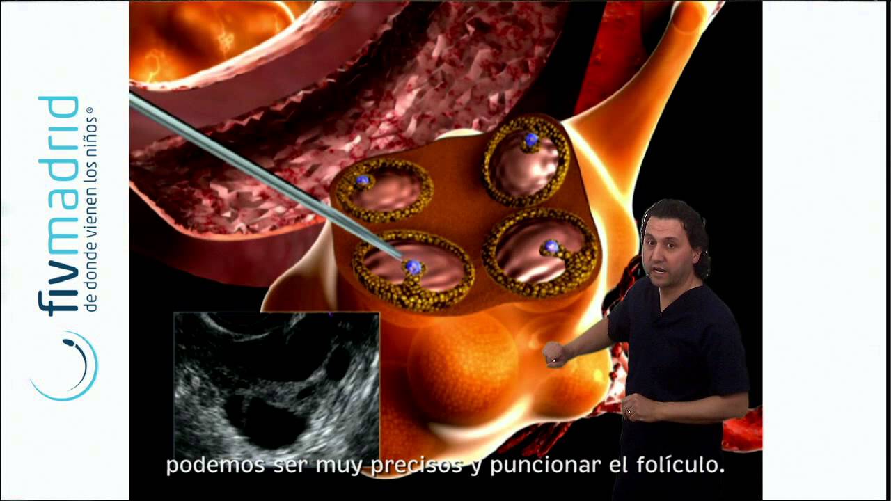 La punción ovárica en la Fecundación In Vitro (FIV)