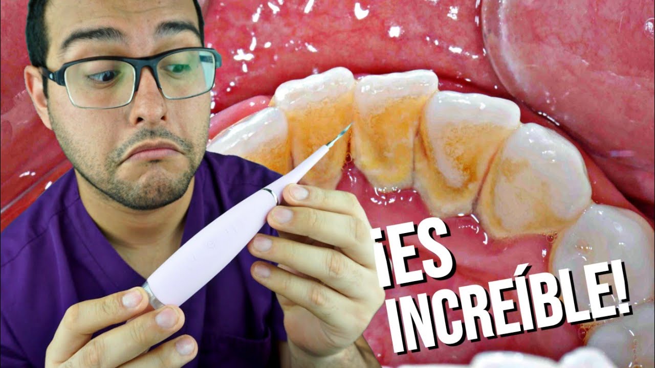 ¡COMO QUITAR EL SARRO 💩 DE LOS DIENTES EN CASA 🏡! ¡ES EN SERIO!