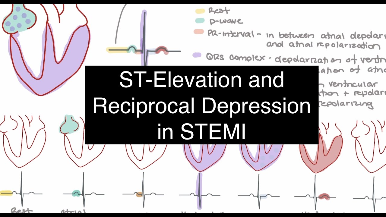 ST Elevation and Reciprocal Depression in STEMI