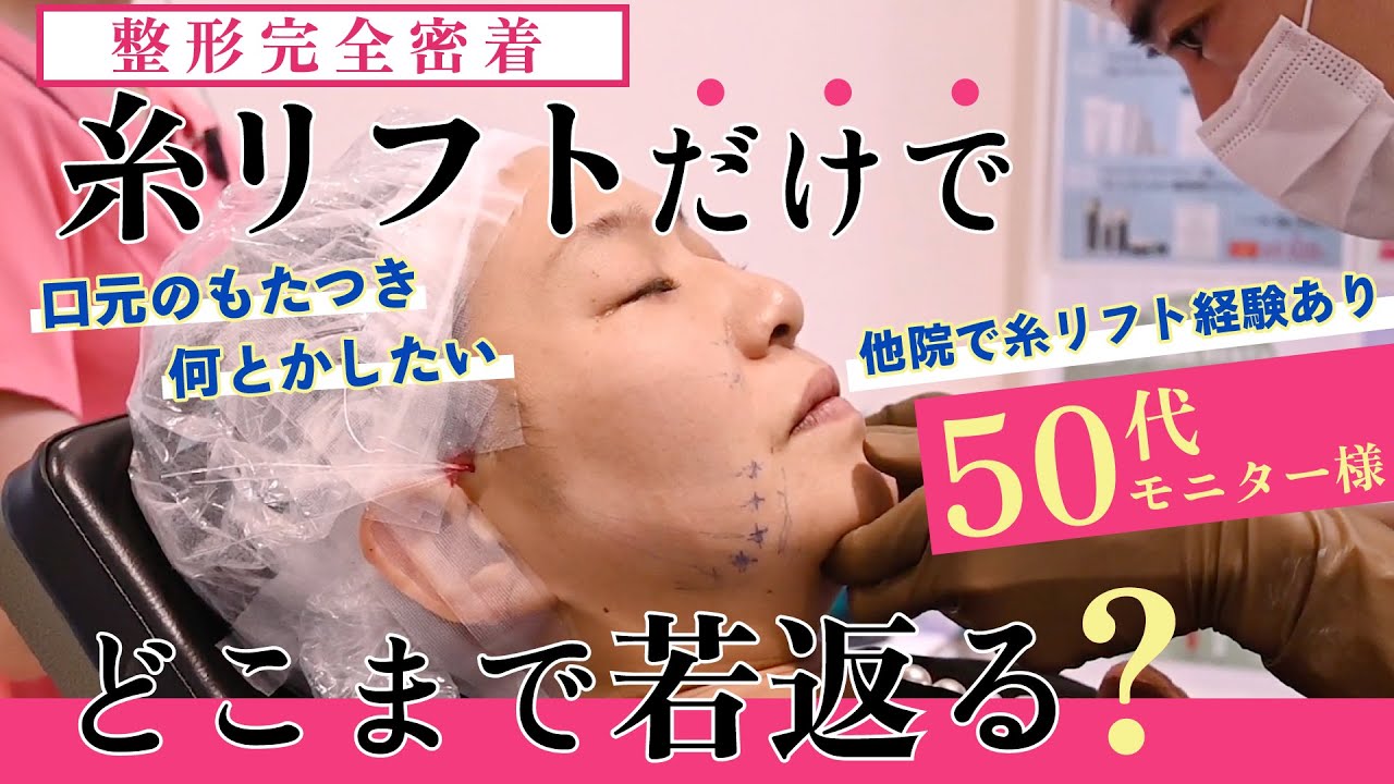 【50代、糸リフトだけでどこまで若返る？】今までどうにもならなかった、口元のたるみ・もたつきをリフトアップ！術後のリアルな感想まで全部お届け！