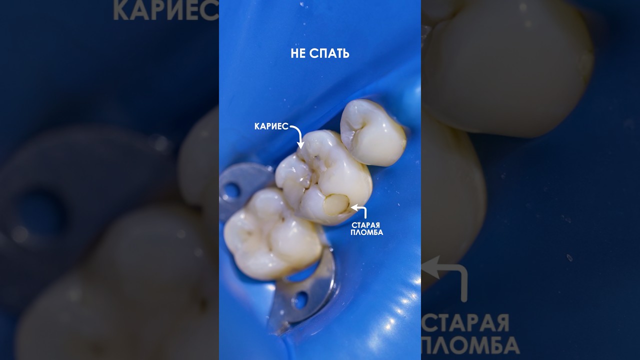 Лечение кариеса от 1.990r. До 6.490r. Подробнее ТG|WA: 8 969 000-40-40 Инстаграм yourclinic.ru