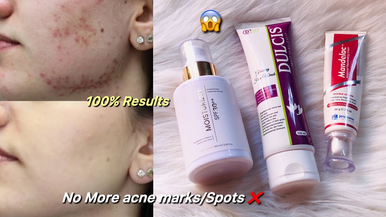 Acne Scars & DarkSpots Treatment | My Top Products for Clear Skin