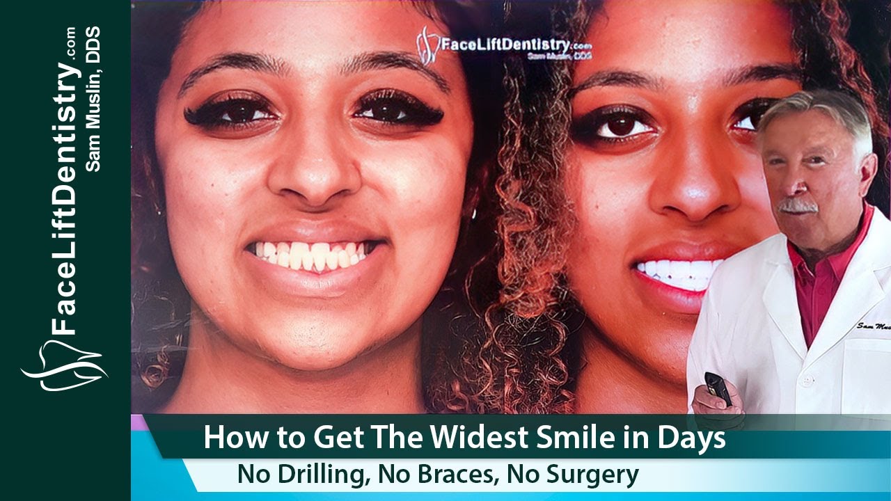 How to Get the Widest Smile and Whiter Teeth in Days