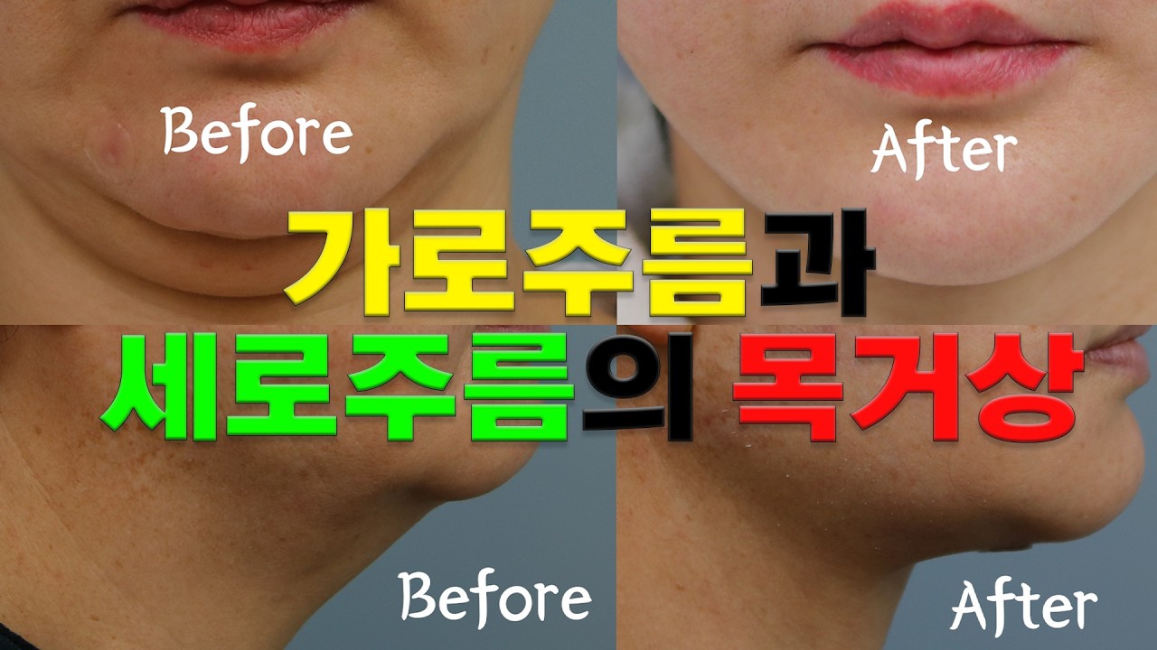 [코코성형외과] 가로주름과 세로주름의 목거상