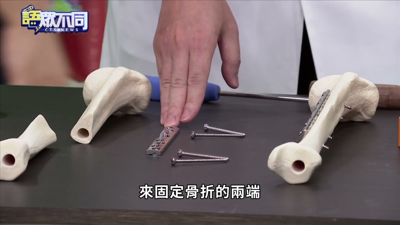 骨折千萬別動? 想快快好.骨科醫師曝關鍵術｜語眾不同｜來賓：林睿誠｜華視新聞 20221024
