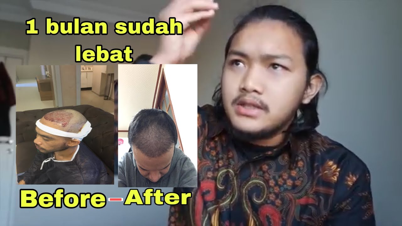 TANAM RAMBUT TRANSPLANTASI DI TURKI