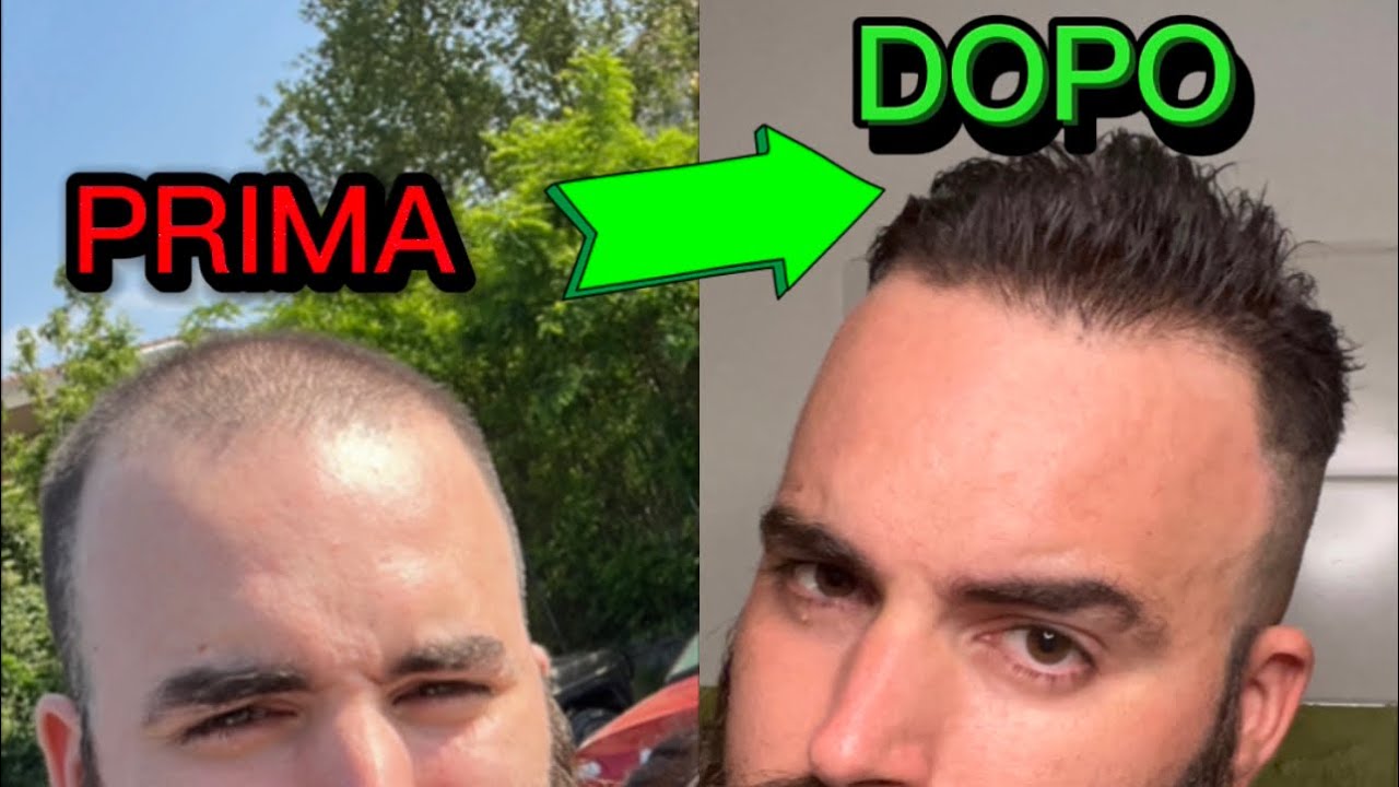 CADUTA CAPELLI/TRATTAMENTO CALVIZIE /HAIRLOSS TREATMENT 