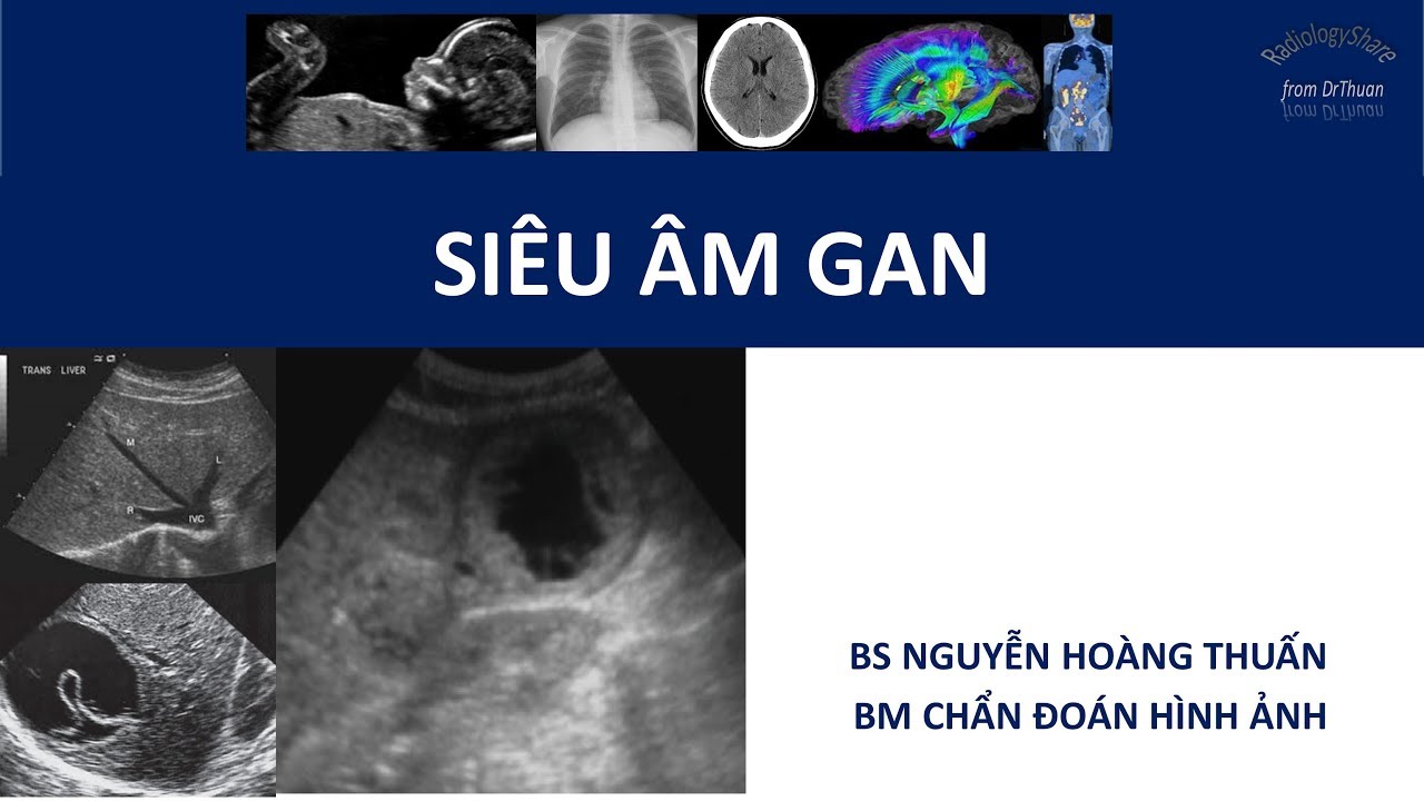 Siêu âm gan phần 3 Bệnh lý dạng đặc