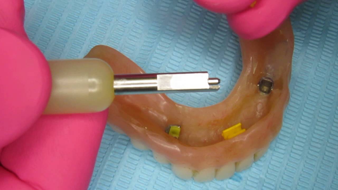Replacement of a Bredent or Allegro Denture Attachment