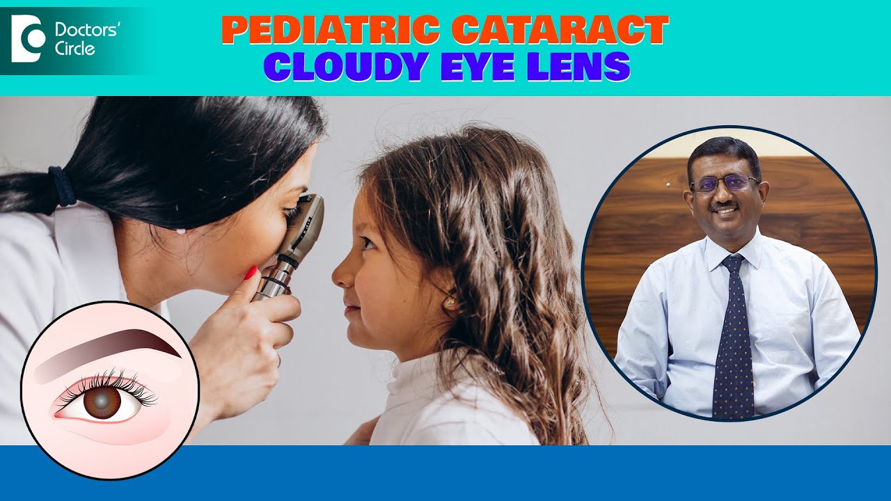 CLOUDY EYE or Cataract in Children|Pediatric Cataract Treatment-Dr.Sriram Ramalingam|Doctors' Circle