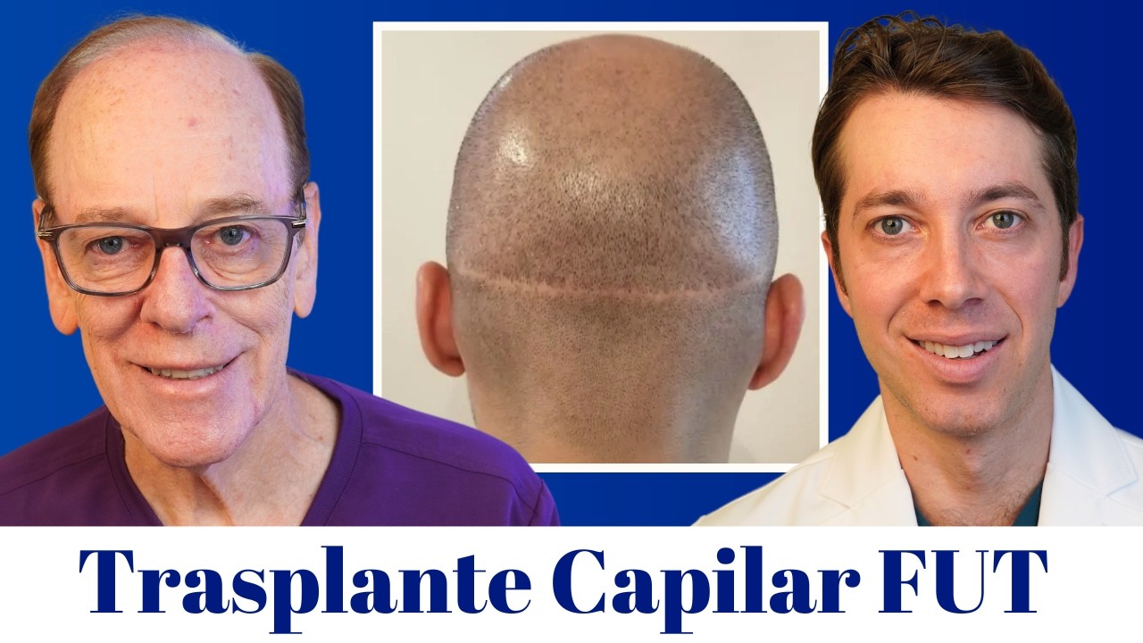 ¿Debería hacerse un trasplante de cabello FUT?