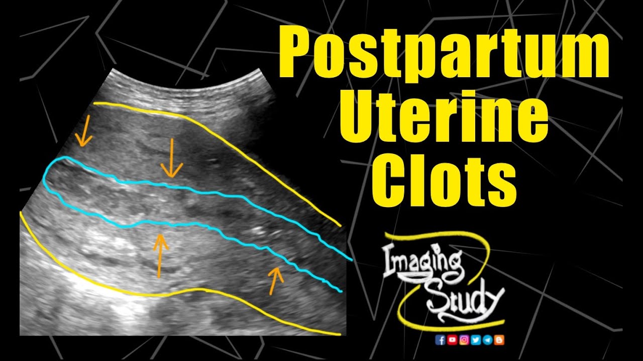 Postpartum Uterine Blood Clots || Ultrasound || Case 210