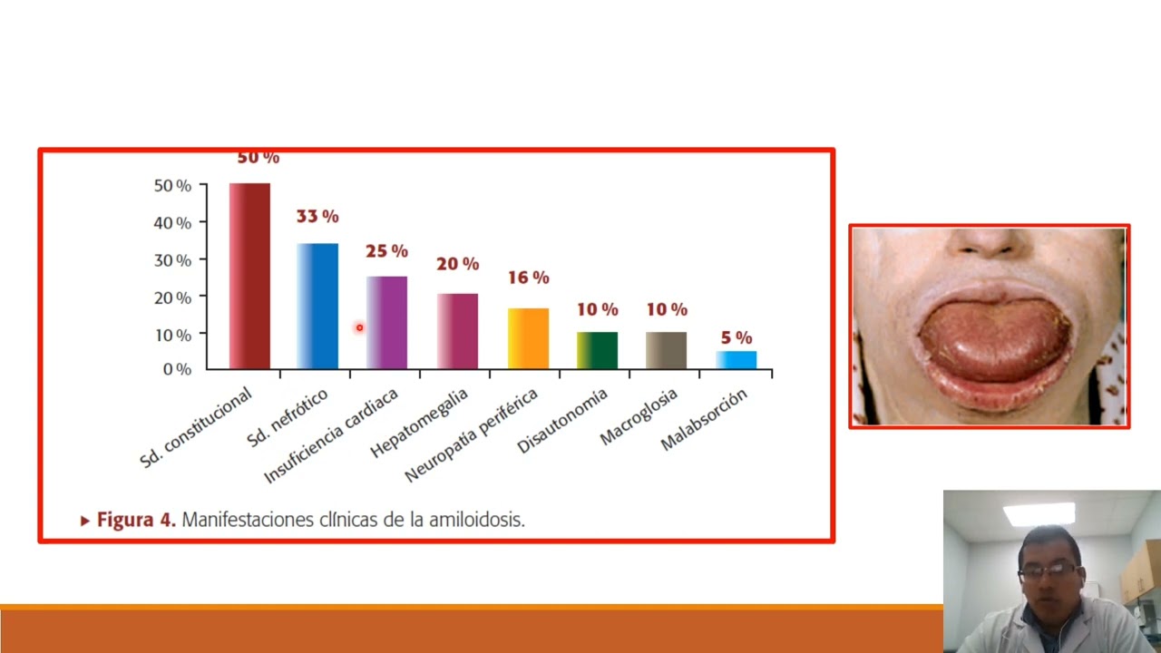 AMILOIDOSIS