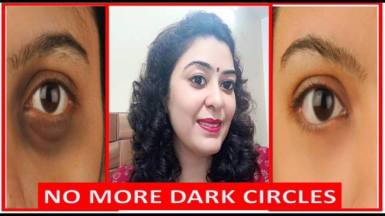 इसे सिर्फ़ 5 दिन लगाने से मेरे dark circles & wrinkles हमेशा के लिए चले गये Remove under eye circles