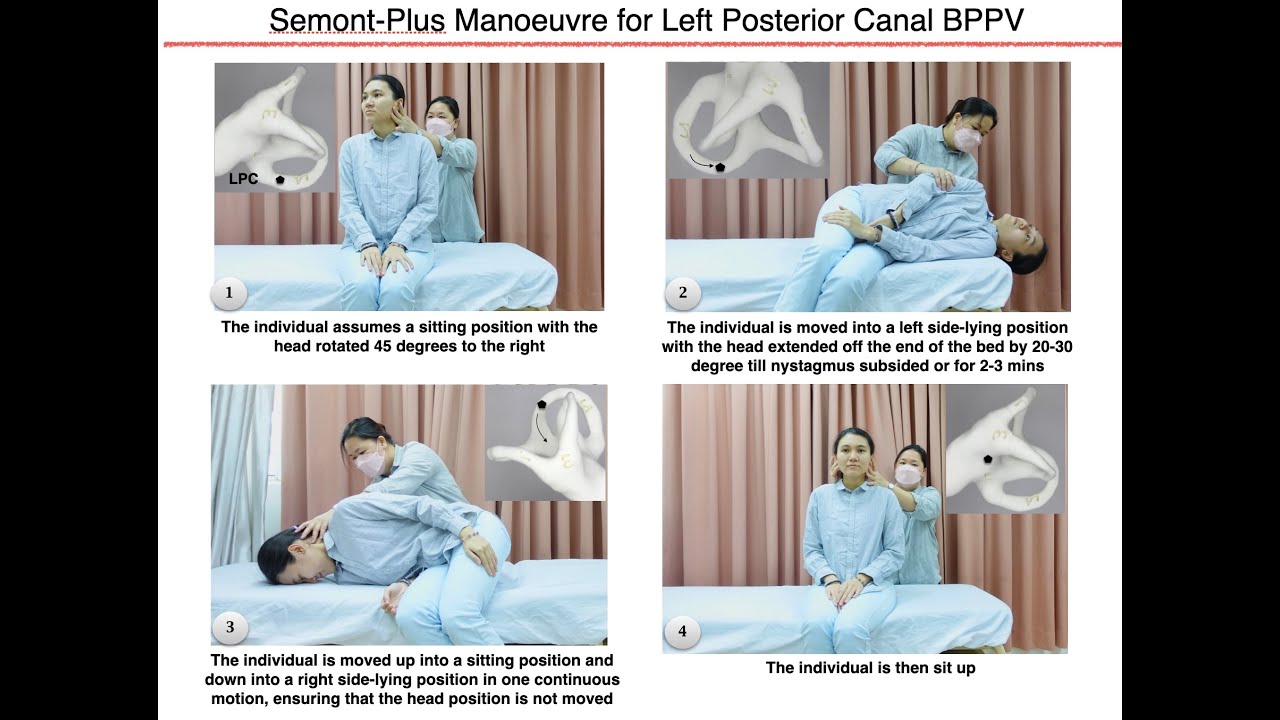 Semont-Plus Manoeuvre for Left Posterior Canal BPPV