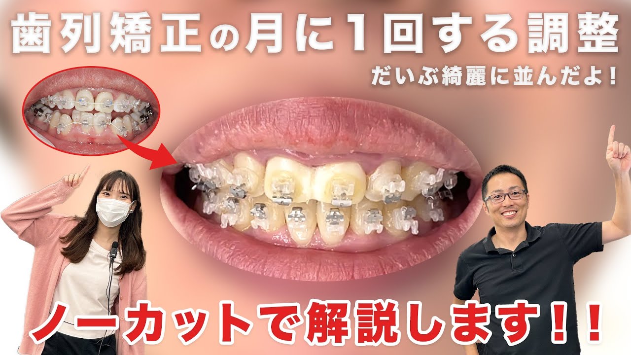 【ノーカット】調整の様子全て見せます【歯列矯正】
