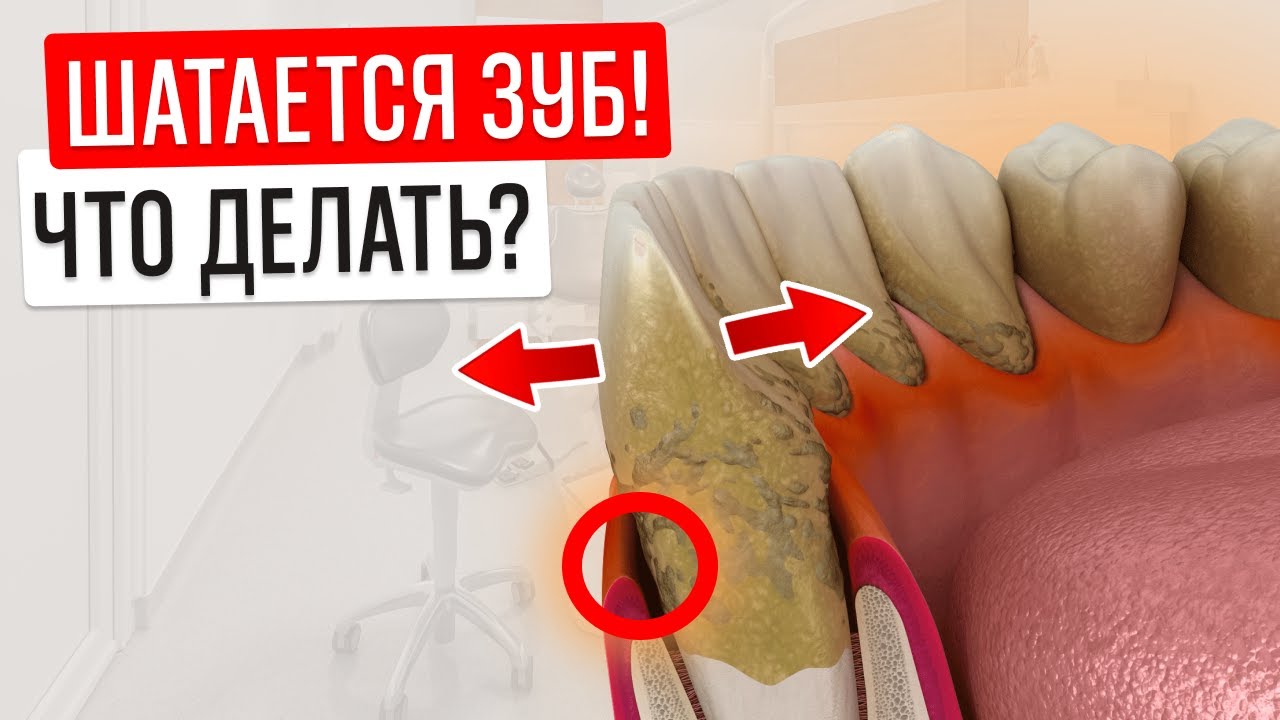 Это СПАСЕТ от потери зуба! ЧТО делать, если шатается зуб?