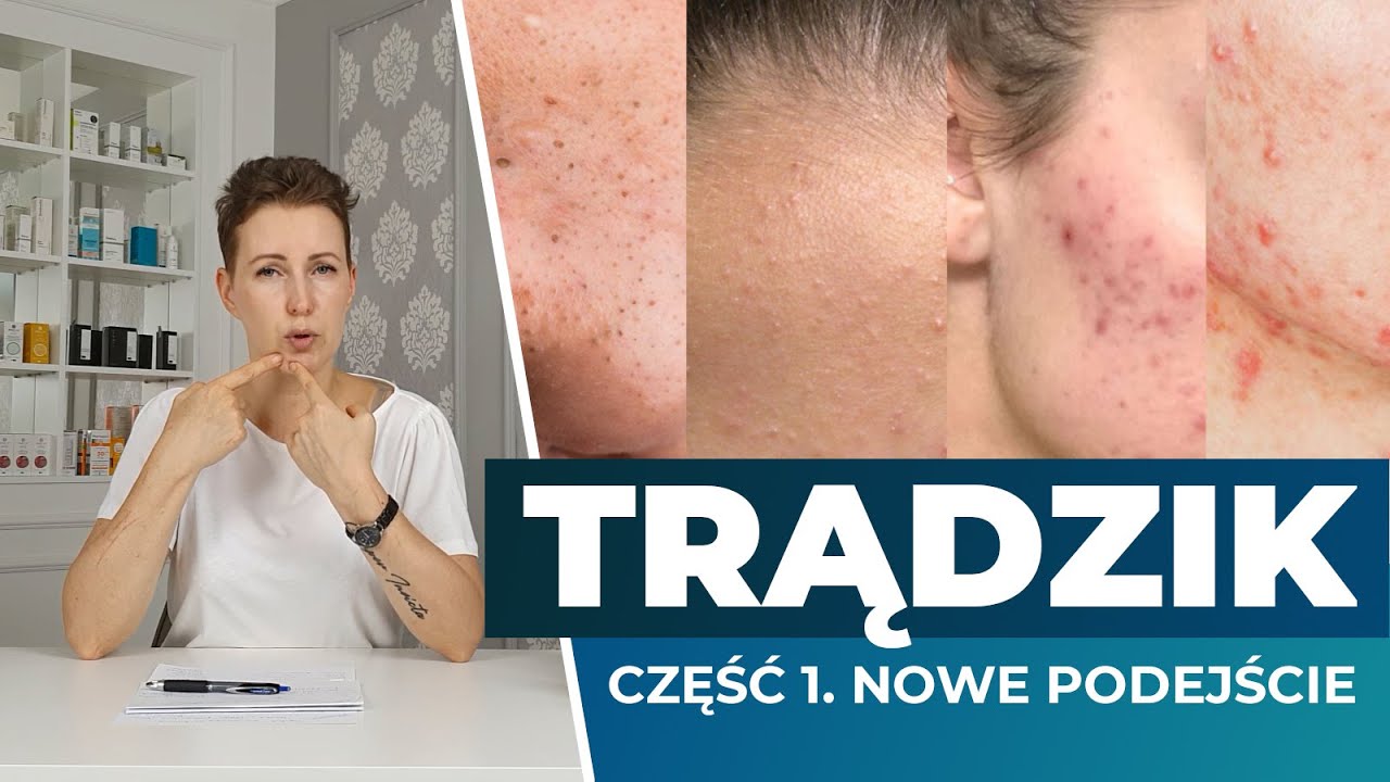 (Nie)kończąca się opowieść o TRĄDZIKU. Część 1 - nowe podejście i podstawy!