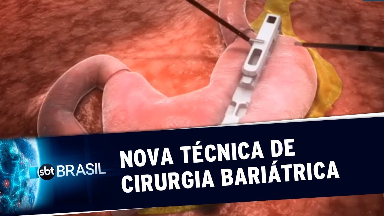 Nova técnica de cirurgia bariátrica chega à rede pública de saúde | SBT Brasil (07/03/20)