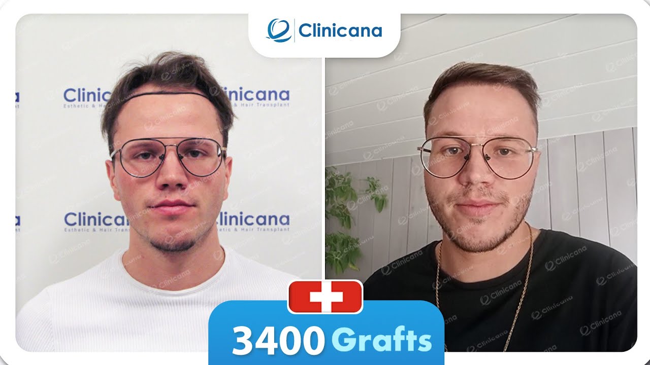 Résultat de greffe de cheveux de Sunny méthode micro fue sapphire