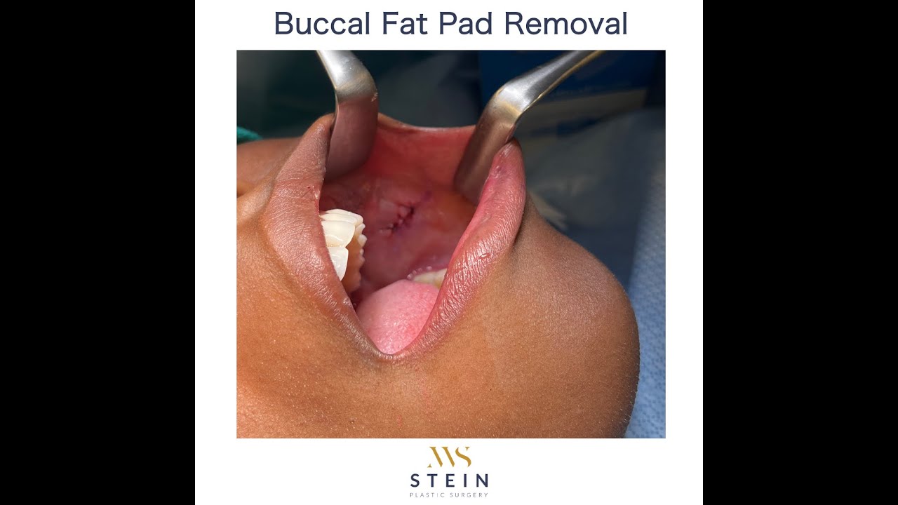 Buccal Fat Pad Removal