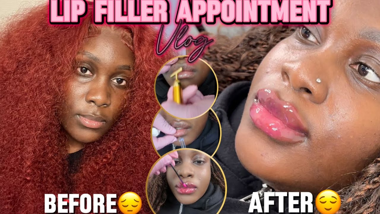 LIP FILLER VLOG ON BLACK GIRL/WOMAN 🫦💉 + RAW & UNCUT (FULL EXPERIENCE)