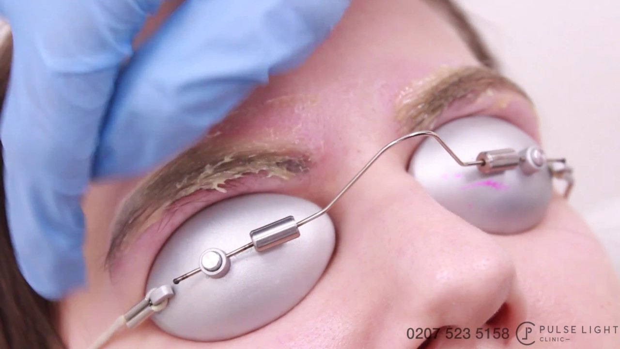 Laser Eyebrow Tattoo Removal Procedure Treatment with PicoWay Pulse Light Clinic