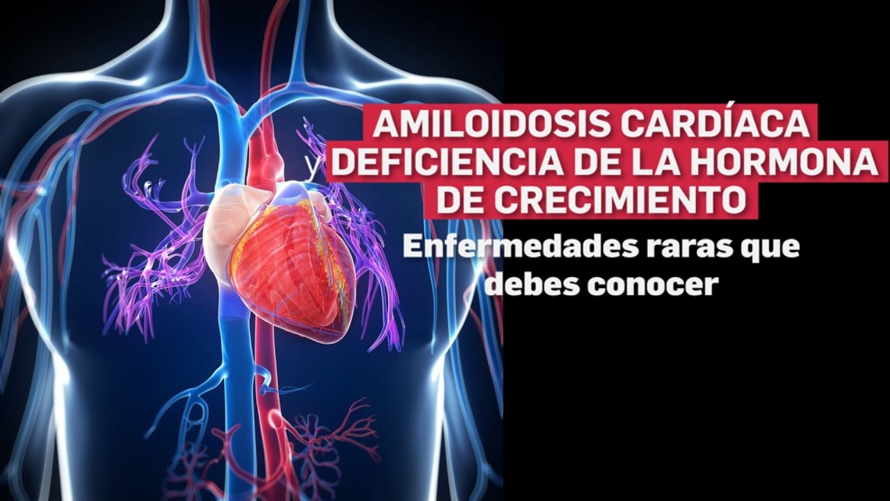 AMILOIDOSIS CARDIACA Y DEFICENCIA DE LA HORMONA DE CRECIMIENTO