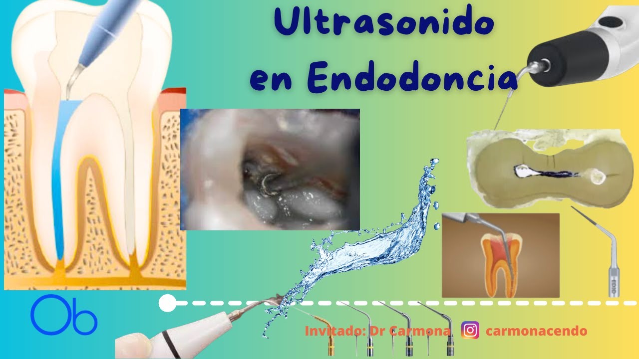 Ultrasonido en Endodoncia