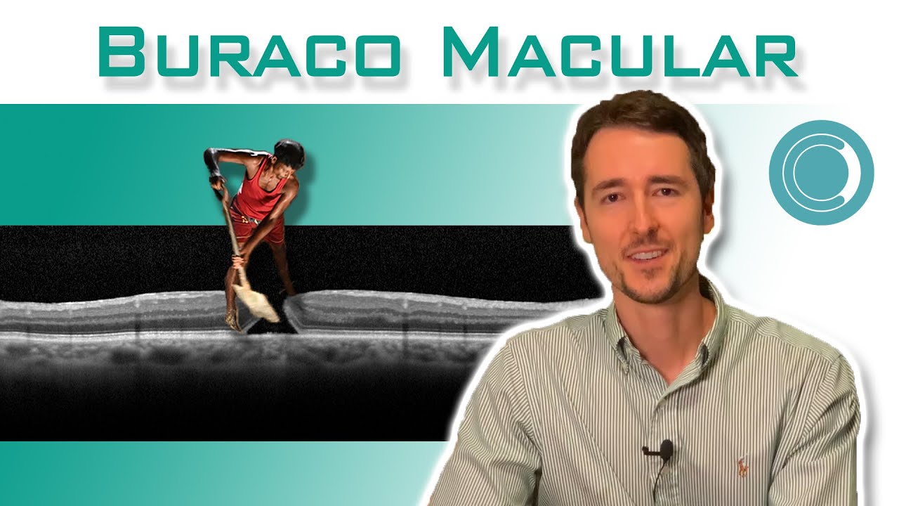 Buraco Macular | Retina e V&iacute;treo