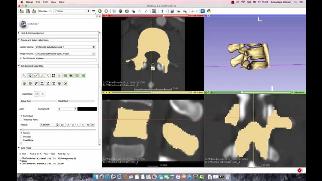 Учебное пособие по 3D-слайсеру: как сегментировать поясничный позвонок