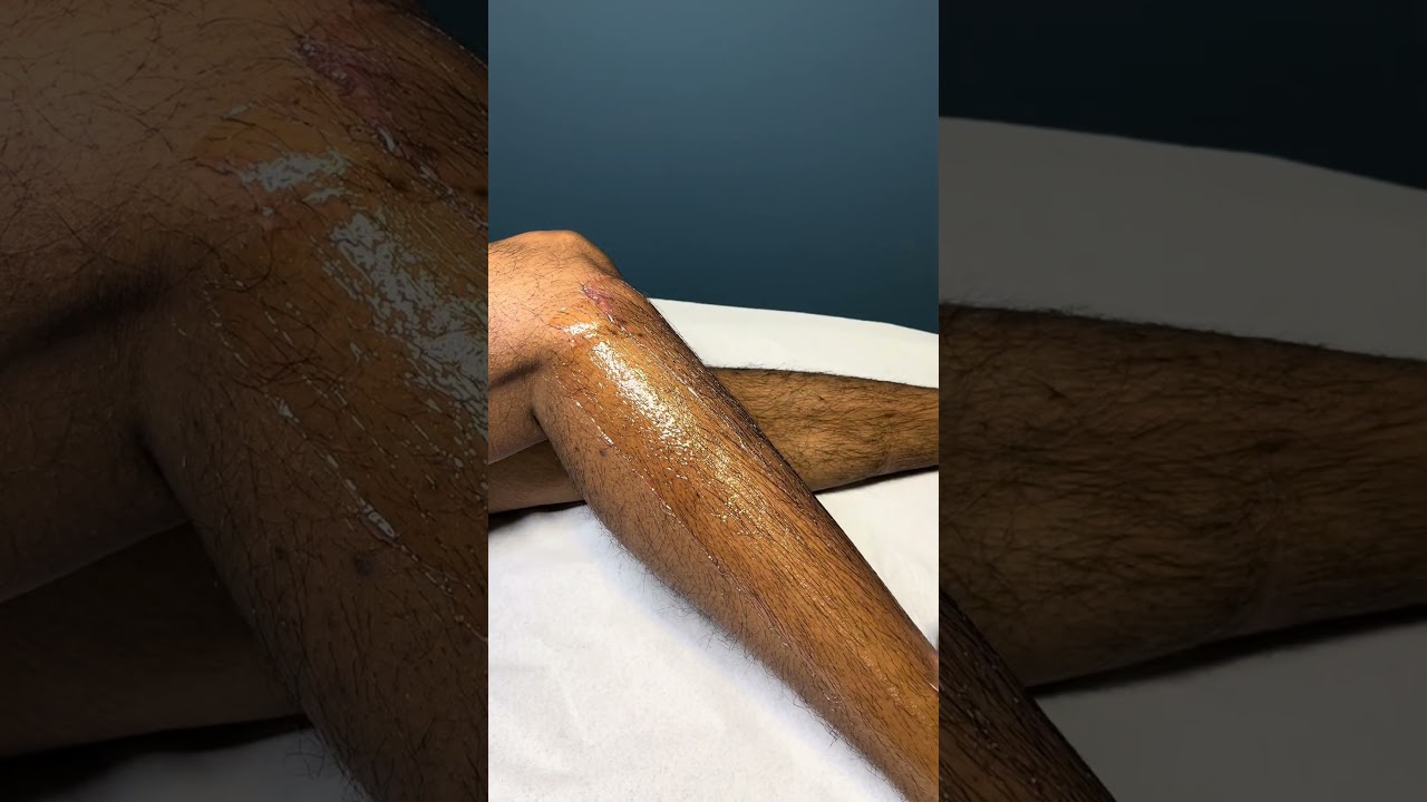 Full leg hair removal with strip wax #hairremoval #youtubeshorts #waxing #fyp #legwaxing #viralvideo