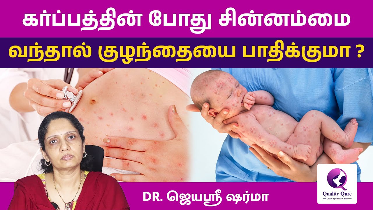 Chickenpox in Pregnancy | கர்ப்பத்தின் போது சின்னம்மை வந்தால் குழந்தையை பாதிக்குமா ? #pregnancycare