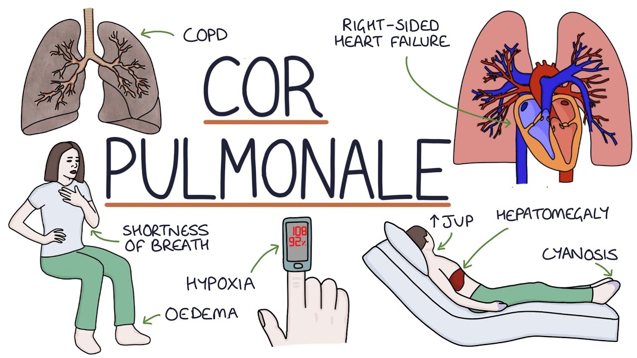 Understanding Cor Pulmonale