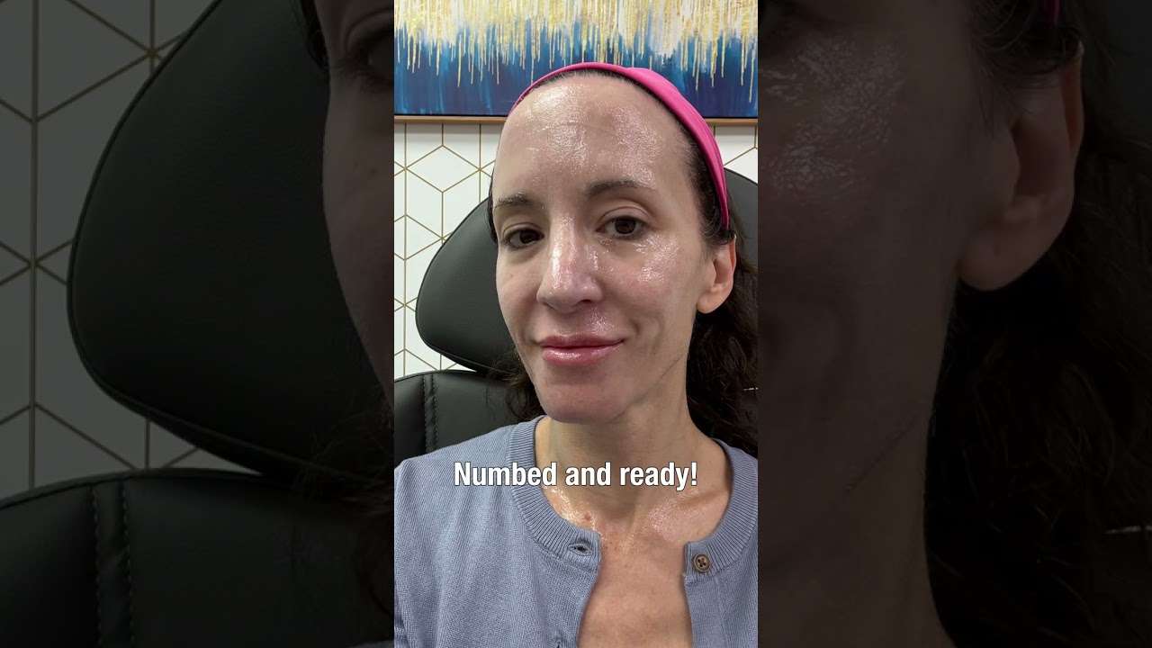 Morpheus8 RF Microneedling | Treatment + Before & After