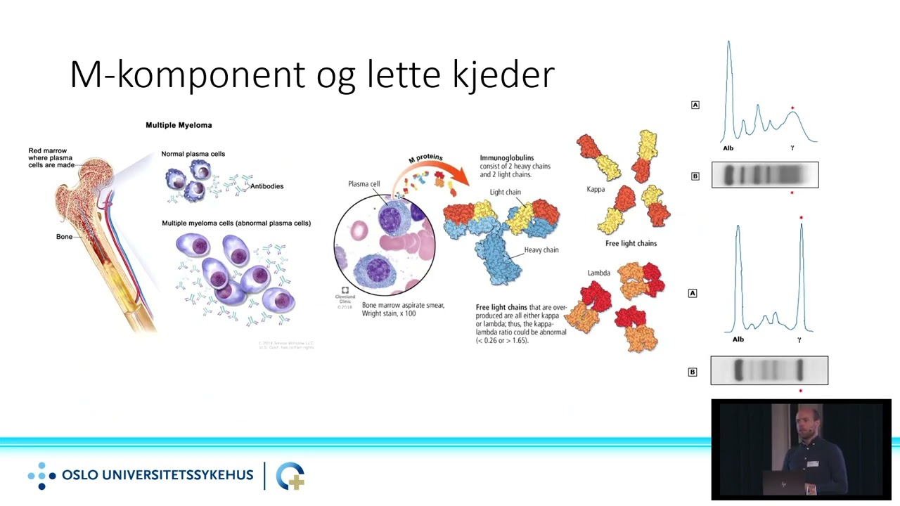 Hva er myelomatose og hvordan behandles det i Norge?