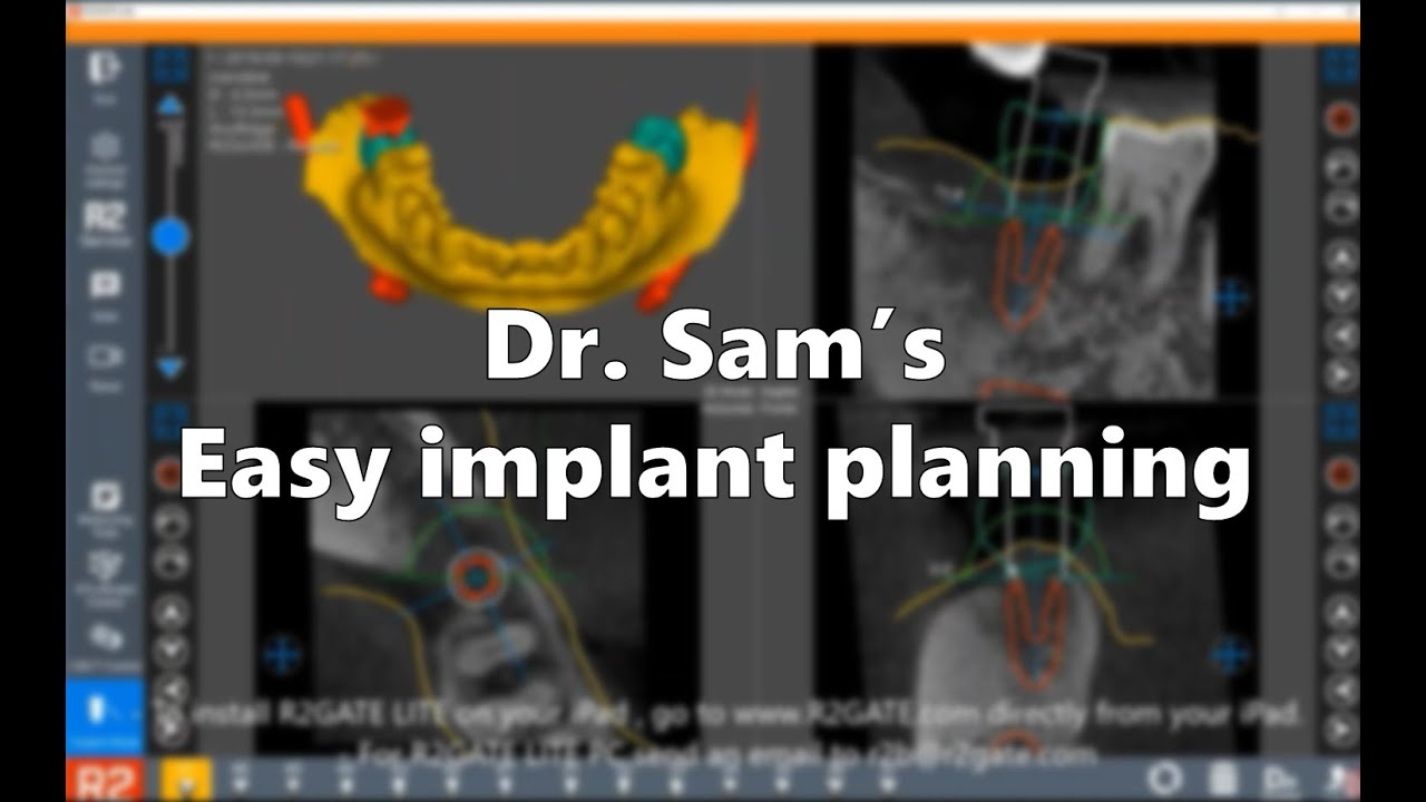 R2GATE 2 0, Implant planning & guide design work flow[EN]