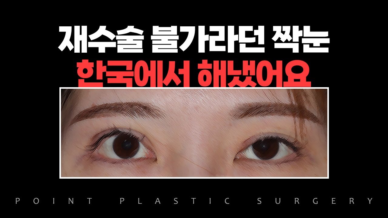 [눈성형/수술전후] 눈매교정 부작용으로 퇴축교정, 짝눈 수술전후