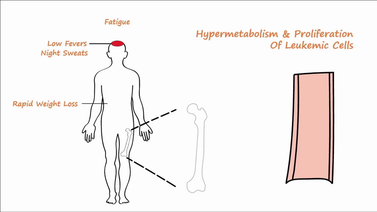 Acute Leukemia - Part 1