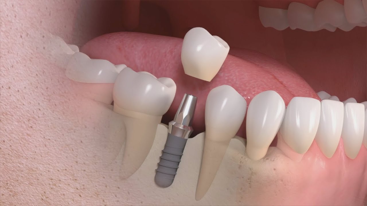 Straumann - Trattamento singolo dente su impianto
