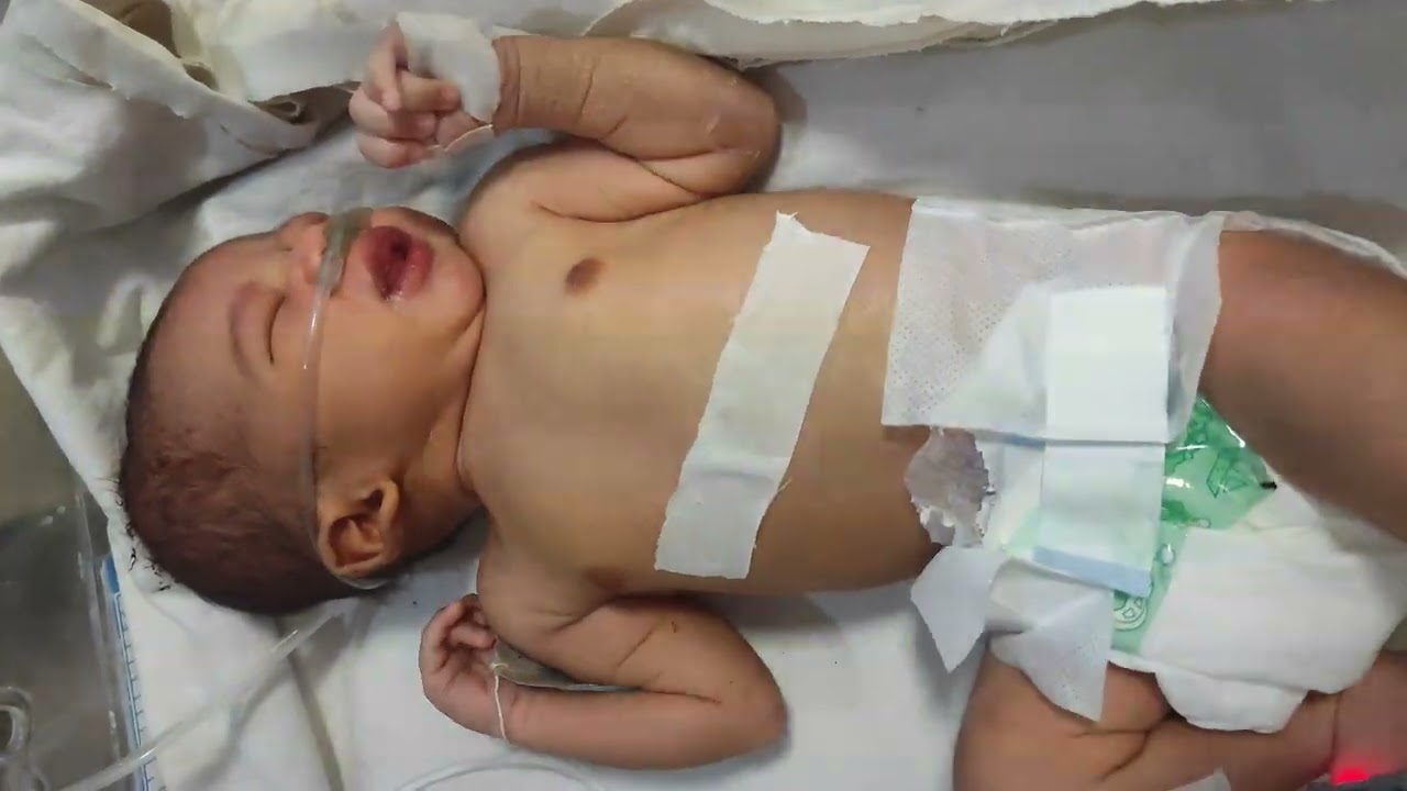 NEONATAL CARE TREATMENT IN NICU 