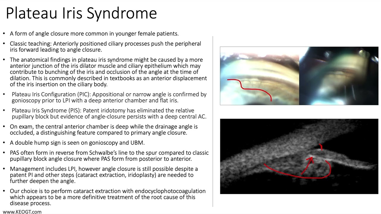 Lecture: Plateau Iris Syndrome (1 Slide in 5 Minutes)