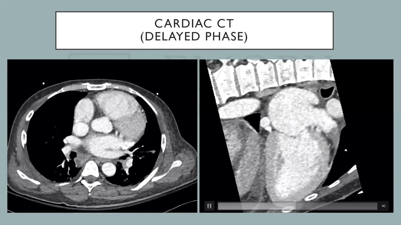 The Stunning Left Atrial Appendage