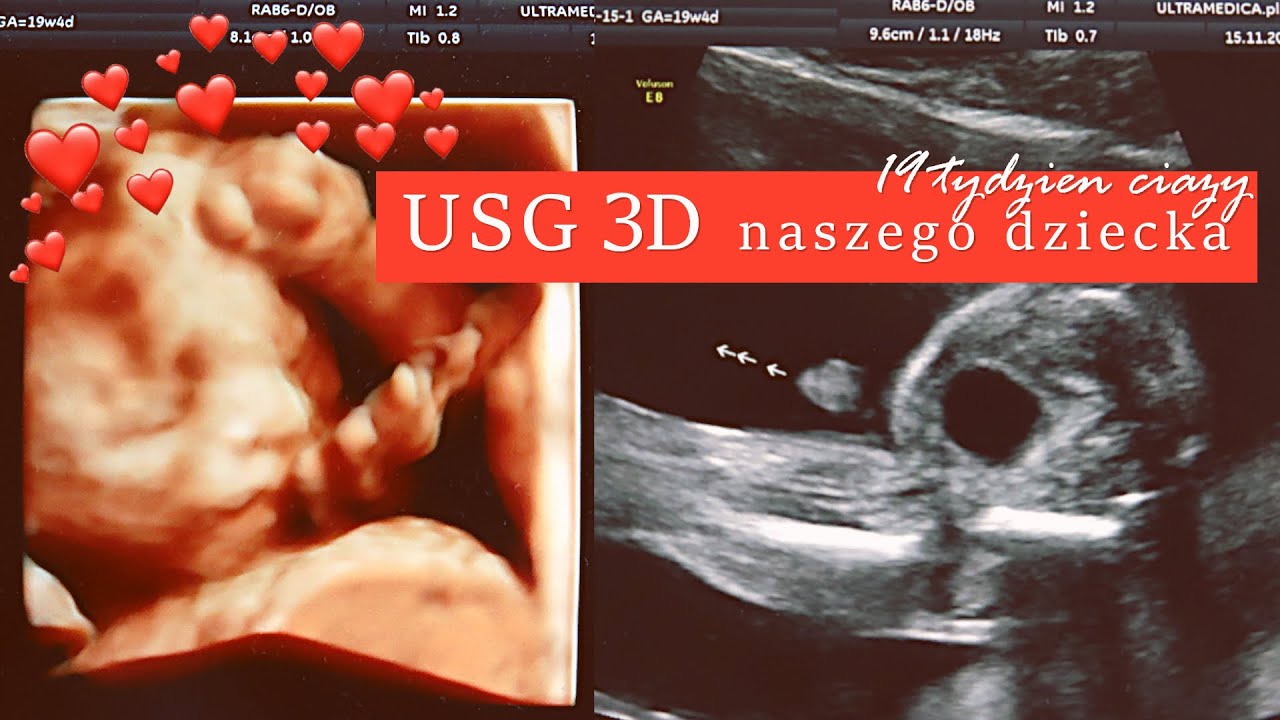 USG 3D DRUGI TRYMESTR CIĄŻY | 19 TYDZIEŃ CIĄŻY | MAJKA MARIA BA