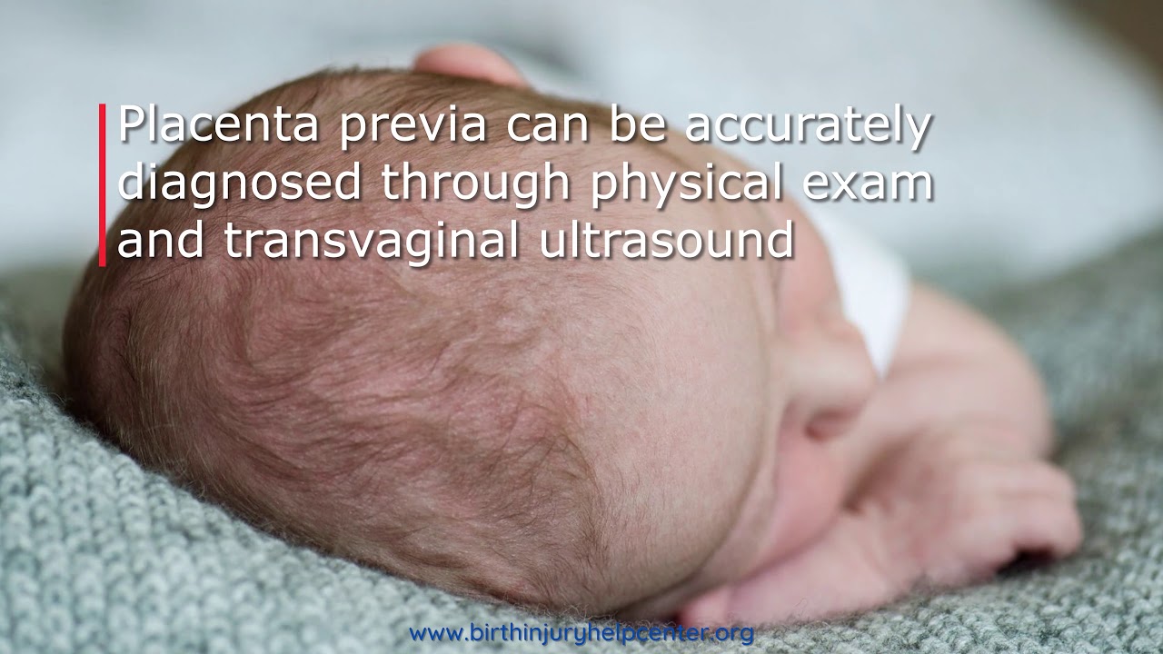 Cephalohematoma in Newborns