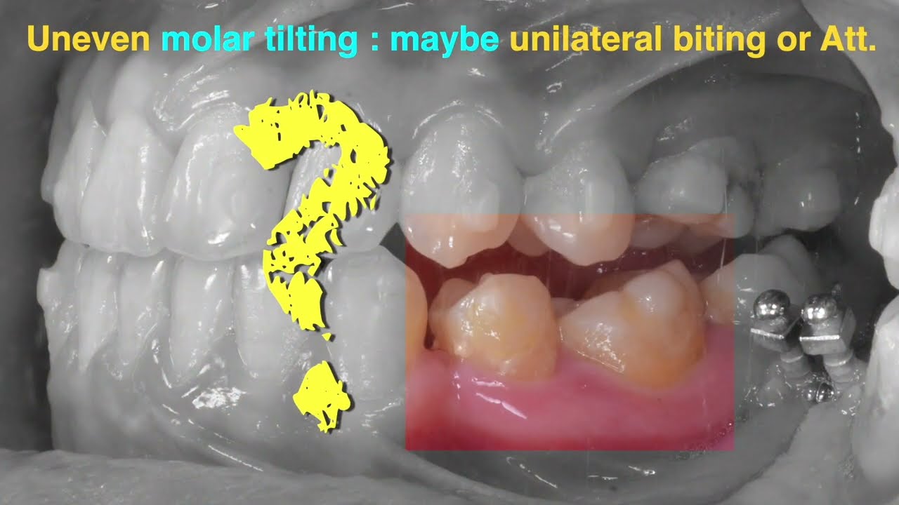 Treatment of Class III Malocclusion with Clear Aligner｜【Chris Chang Ortho】CC711