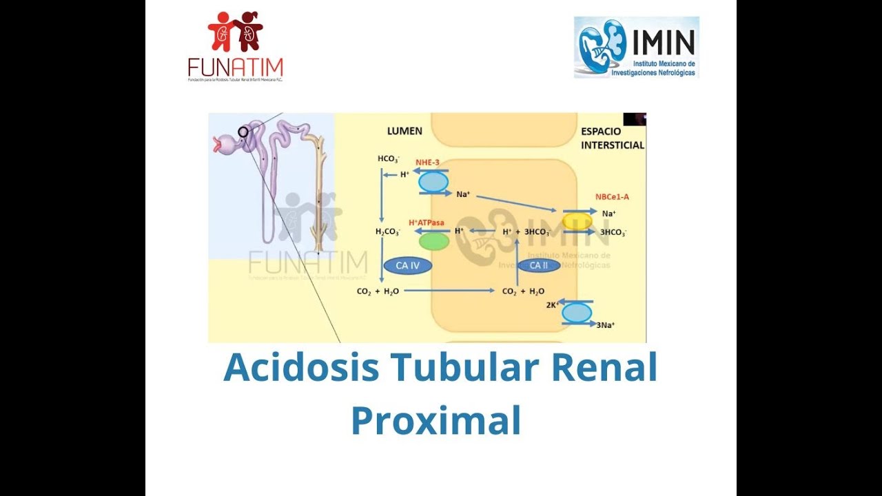 Acidosis Tubular Renal Proximal. Dra. Norma Guerra